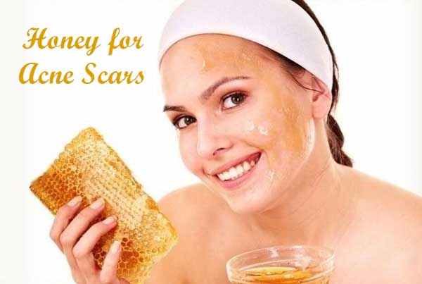 Honey for Acne Scars
